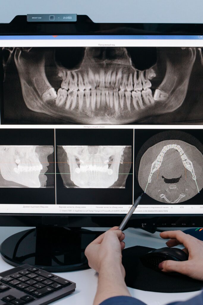 Jawbone X-ray displayed on a computer monitor