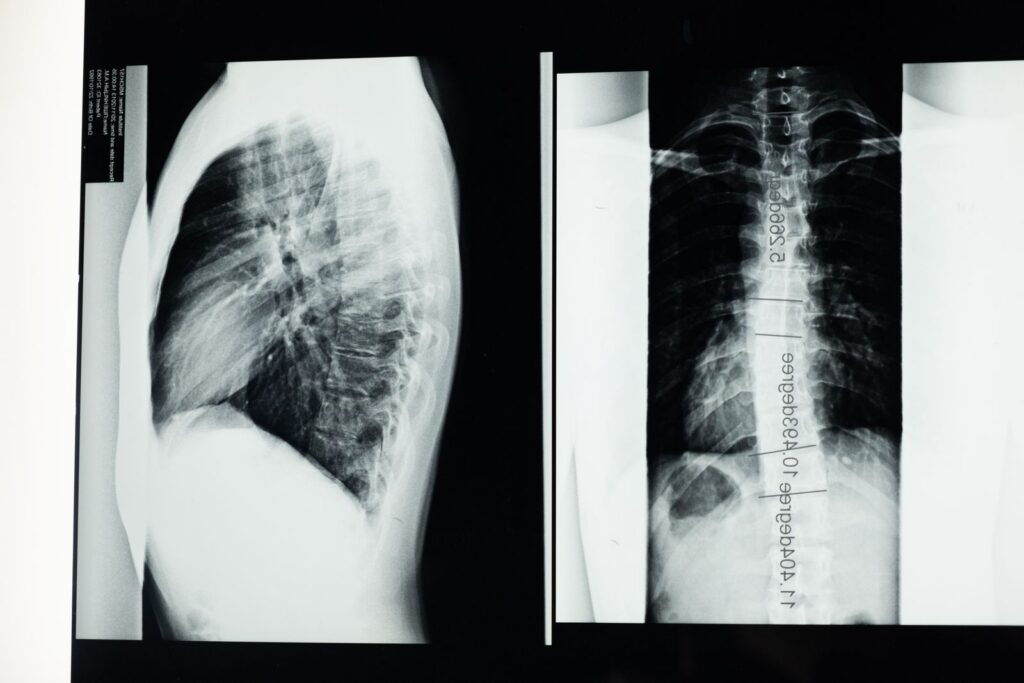 X-ray images of a human spine on a light panel